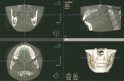 歯科用CT