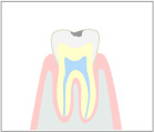 軽度の虫歯