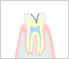 中度の虫歯