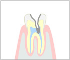 重度の虫歯