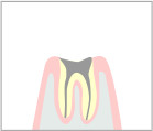 最重度の虫歯
