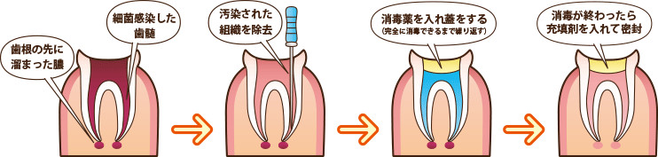 根管治療の流れ