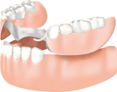 複数歯